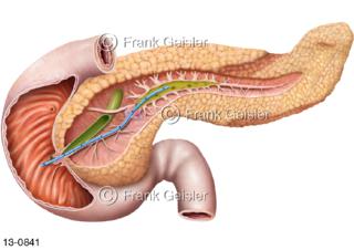 Bauchspeicheldrüse Pankreas, Stau Pankreassaft, Bauchspeichelgang mit Stent