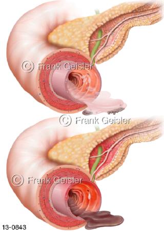 Dünndarm Duodenum mit Pankreasinsuffizienz