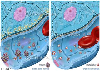 Zellen der Bauchspeicheldrüse, Betazelle im Pankreas mit Insulin in Blutkapillare, Diabetes mellitus