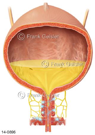 Harnblase, neurogene Blase Harninkontinenz