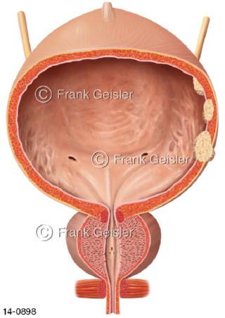 Blasentumor Urothelkarzinom Blasenkrebs