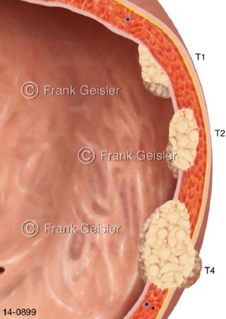 Phasen Urothelkarzinom Blasenkrebs Blasentumor