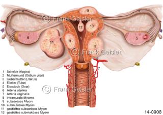 Uterus myomatosus, Vergrößerung Uterus durch Myome, Uterusmyome der Gebärmutter
