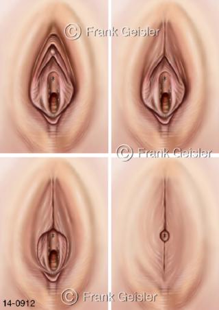 Genitalien Frau, Genitalverstümmelungen Vulva