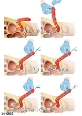 Penis mit Katheter Katheterisierung Harnblase
