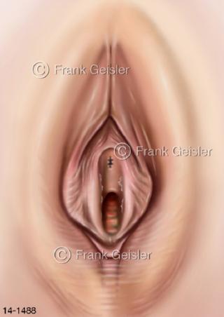 Genitalien FGM FGC Klitoris, Klitoridektomie