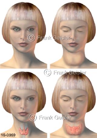 Schilddrüse normal, vergrößert Struma Kropf