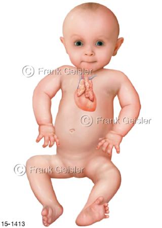 Herz mit Thymus Bries bei Kind Baby