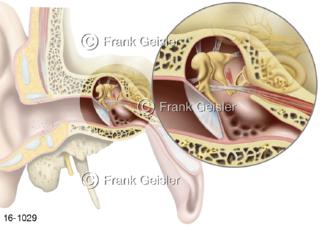 Gehörorgan Mittelohr Ohr, Zoom Innenohr im Felsenbein durchscheinend