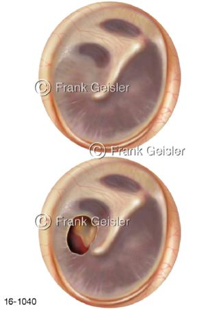 Ansichten Trommelfell, Loch und Gehörknöchelchen