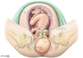 Geburt Kind,  Geburtsphase Austreibungsphase Austreibungsperiode