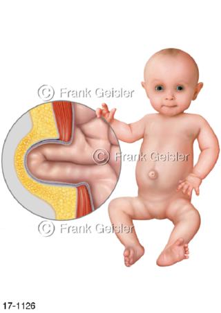 Kind Kleinkind Baby mit Nabelbruch, Nabelhernie durch Schwäche der Bauchdecke 