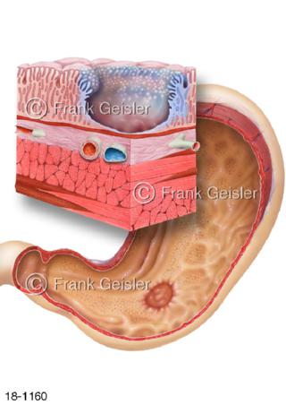 Erkrankung Magen, Ulkus Magenschleimhaut