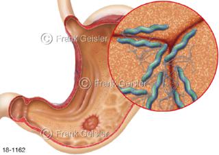 Erkrankung Magen mit Magenulkus durch Bakterien Bakterium Helicobacter pylori