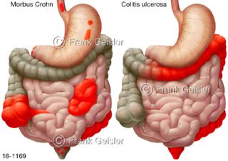 Regionen Darm mit Zonen Morbus Crohn und Colitis ulcerosa