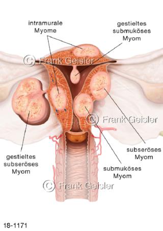 Uterus myomatosus Myome der Gebärmutter