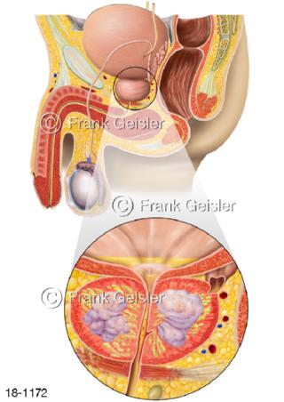 Benignes Prostata Hyperplasie Syndrom BPH