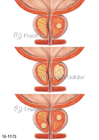 Vorsteherdrüse Prostataerkrankung Prostatakrebs Prostatakarzinom
