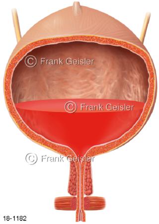 Blut Urin Harnblase, Hämaturie Erythrurie