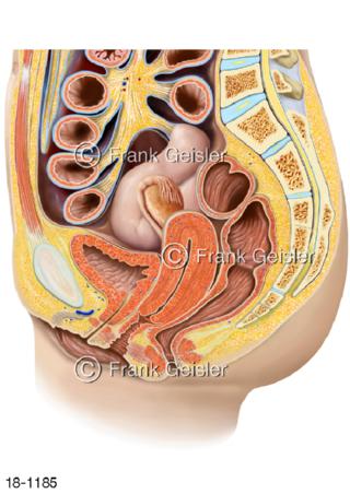 Gebärmuttervorfall, Uterusprolaps Gebärmutter
