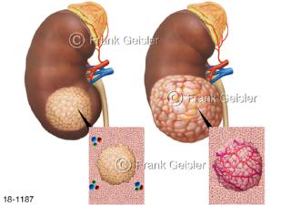 Wachstum Nierenkrebs, Nierentumor Nierenkarzinom Nierenzellkarzinom