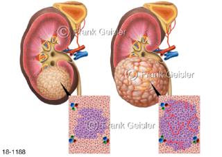 Schnitt durch Niere mit Nierenkrebs, Nierentumor Nierenkarzinom Nierenzellkarzinom
