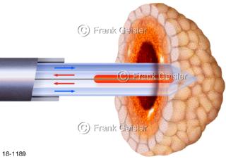 Tumor Geschwulst, Tumorbehandlung mit laserinduzierte Thermotherapie