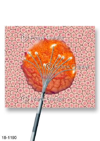 Tumorbehandlung, Thermotherapie Zellkarzinom