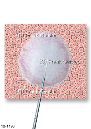 Tumorbehandlung, Kryotherapie Kältetherapie