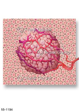 Tumorbehandlung, selektive interne Strahlentherapie SIRT