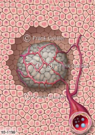 Therapie Tumor Krebs Karzinom mit Angiogenesehemmer
