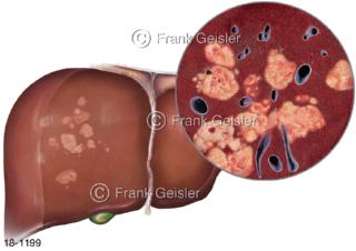 Erkrankung Leber, Lebertumoren bösartiger Leberkrebs hepatozelluläres Karzinom