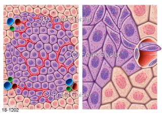 Erkrankung Nieren, Nierentumor Nierenzellkarzinom mit Krebszellen