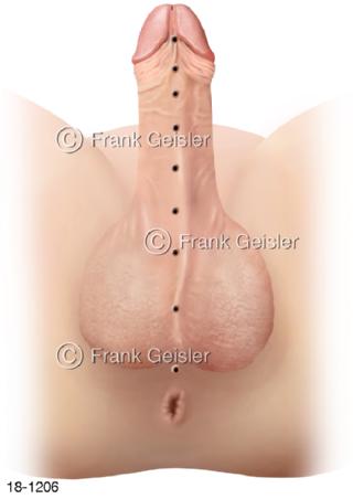 Hypospadie, Fehlbildung Harnröhre Penis