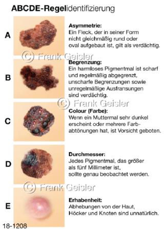 ABCDE-Regel Muttermale Haut, Hautveränderungen Hautkrebs