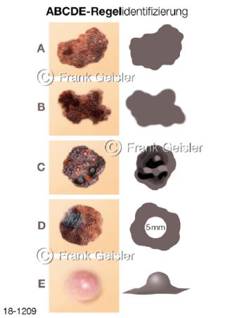 ABCDE-Regel Muttermale Haut, Hautveränderungen Hautkrebs