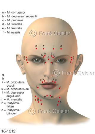 Injektionspunkte Botox Gesicht Hals Frau