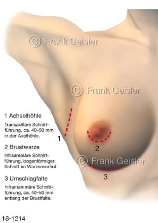 Brust Brustdrüse Schnittmethoden Brust-OP