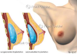 Brust Brustdrüse Frau, Brust-OP Implantate Brustimplantate Brustvergrößerung