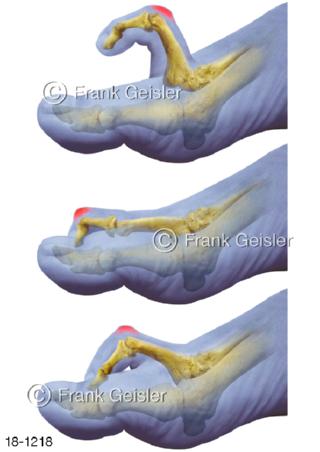 Hammerzeh Digitus malleus, Fehlstellung Zehen
