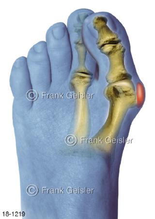 Hallux valgus Ballenzehe Fehlstellung Großzehen