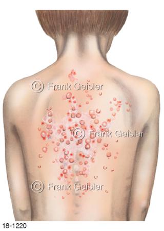 Windpocken Varizellen Viruserkrankung