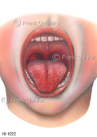 Erdbeerzunge bei Scharlach Scarlatina