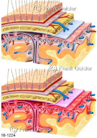 Hirnhautentzündung Meningitis Entzündung Hirnhaut
