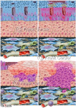 Schleimhaut Lunge, Bronchien, Lungenkrebs Bronchialkrebs