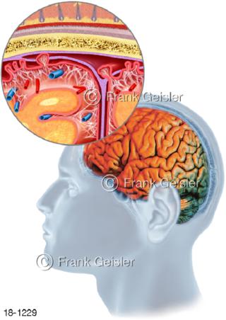 Hirnhautentzündung Meningitis Entzündung Pia mater