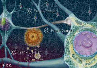 Nerven Hirnrinde Gehirn mit Amyoloid-Plaques bei Alzheimer-Krankheit Demenz