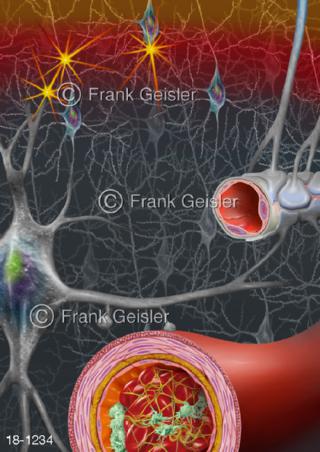  Ischämischer Schlaganfall Hirninfarkt Depolarisationswelle