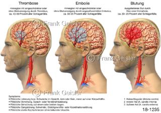 Schlaganfall Apoplex, Schlaganfallformen Thrombose Embolie Blutung