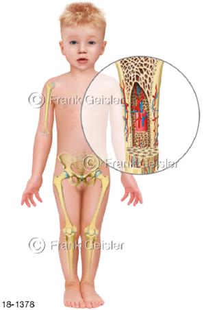 Notfall intraossärer Zugang io Knochenmark Kind